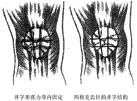 井字形张力带内固定治疗髌骨粉碎性骨折