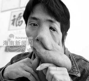 怪脸小伙新年梦想拥有普通人的一张脸
