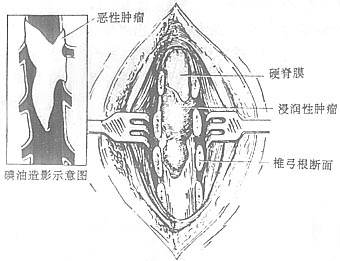 椎管内肿瘤切除术
