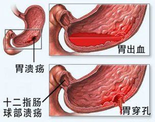 军医提醒：寒冷季节 谨防消化道出血
