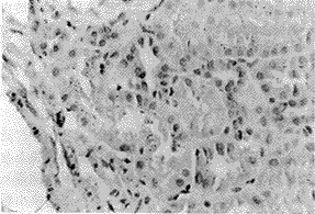 粘附分子选择素在IgA肾病中变化的临床意义