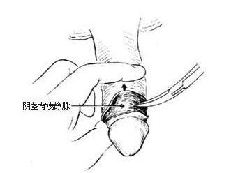 高清：图解包皮手术全过程