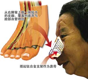 农妇患罕见鼻血管瘤 医生取其脚背肉再造新鼻子