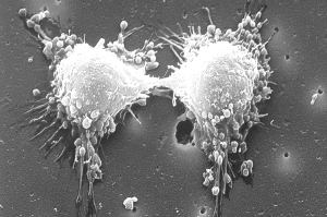 一大型研究发现74种癌症遗传因素 预测个人患癌风险依旧艰难