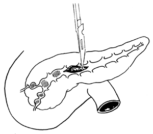 慢性胰腺炎（外科）