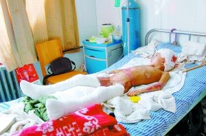男孩滑进炼油废渣池重度烧伤 涉事作坊曾被查处