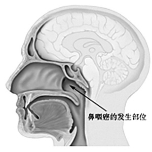 防治鼻咽癌 贵在早期筛查