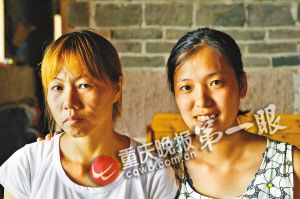 患罕见皮肤松弛症 二十八岁女子长得像六七十岁