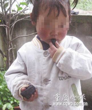 四岁女孩患异食症 每天吃煤一大把身体无大碍