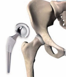 人工关节进口扩大 国内研发应从匹配性突破