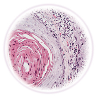 Lung-MAP试验：剑指鳞状细胞肺癌生物标志物和新药评估