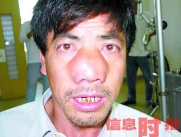 男子患怪病鼻子不停疯长 如蛙伏面20年罕见