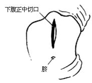 耻骨后根治性前列腺切除术