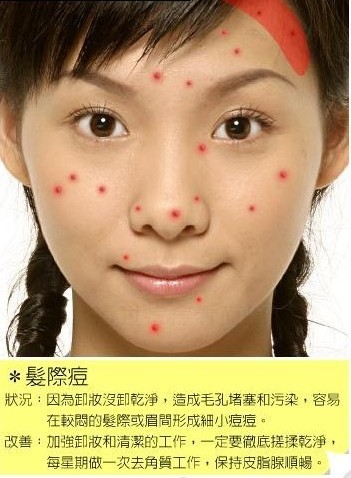 通过脸上痘痘位置看你的健康状况
