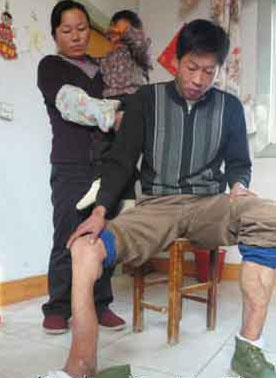 村民腿骨折 手术后腿肚子消失图