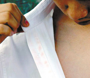 小伙患怪病汗水可将衣服染红