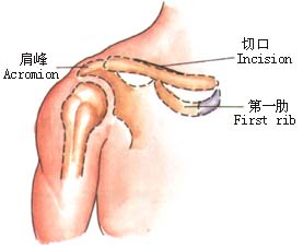 锁骨骨折切开复位内固定术