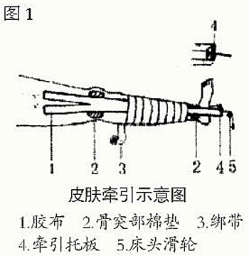 手法治疗小儿股骨干骨折