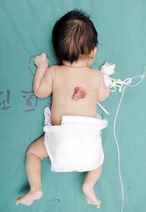 初生男婴背部长生殖器