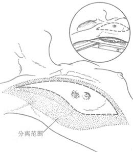 乳癌根治术