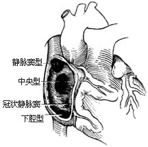 房间隔缺损修补术
