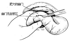 幽门括约肌切开术