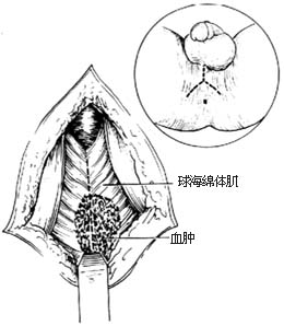 球部尿道损伤修复术
