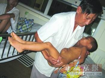全球最恐怖的67种怪病