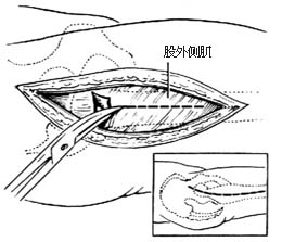 转子间切骨术