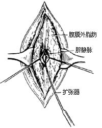 经脐静脉门静脉插管术