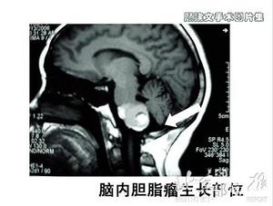 外科医生称手术意外发现人脑里长珍珠