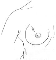 乳房良性肿瘤切除术