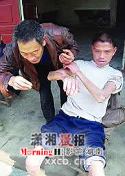 男子患怪病皮肤变硬无法活动
