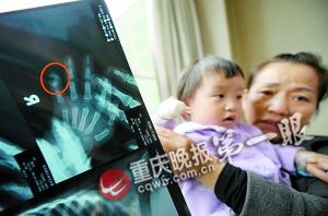 1岁女童手指卡扶梯扯脱指骨 7天找不回就会残疾