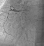 肾移植术后RCA及LAD闭塞病变的PCI