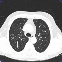 独家：CT肺部筛查高级可视化软件悄然运行