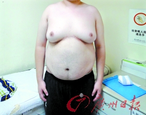 19岁胖男孩乳房重达10斤求医