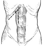 胆囊切除术1