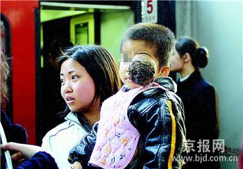 三龄男童患病左眼凸成“煤球”