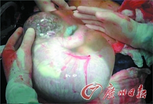 新生儿包裹“完好羊水囊”出世