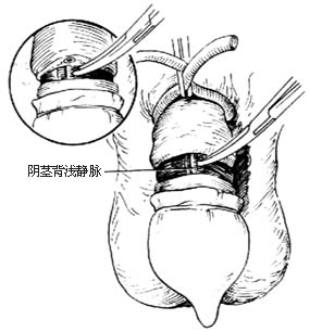 阴茎部分切除术