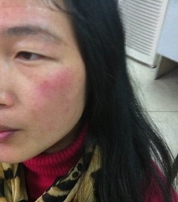 玉兰油过敏 宝洁1元精神损失赔偿被诉欺人太甚