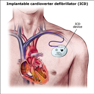 ICD，1/3患者未获益？