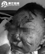 浙江19月大幼儿被恶犬咬至毁容 脸缝上百针