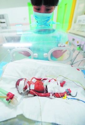 婴儿出生体重仅500克 整个身体比成人巴掌稍大