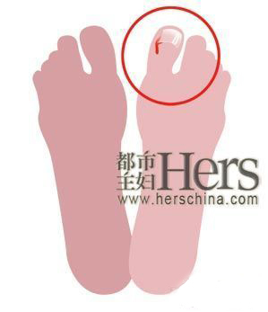 第六大问题：趾甲嵌到了肉里