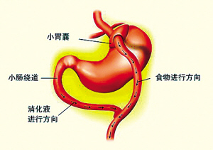微创手术能治重度肥胖