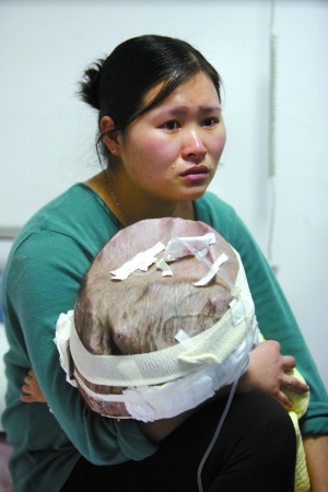 1岁女婴患脑积水头大如篮球 手术费无着落
