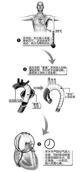 医生将患者全身速冻降温至20℃ 24分钟开胸补心