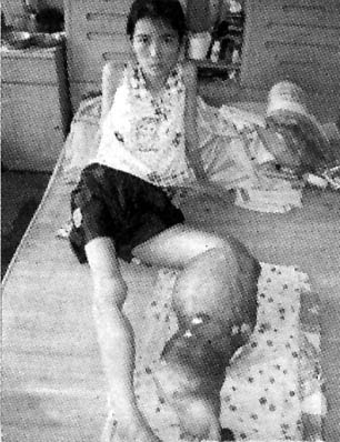妙龄女患怪病：小腿像孕妇肚子天天“涨”